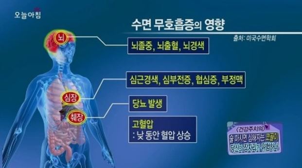 수면무호흡증